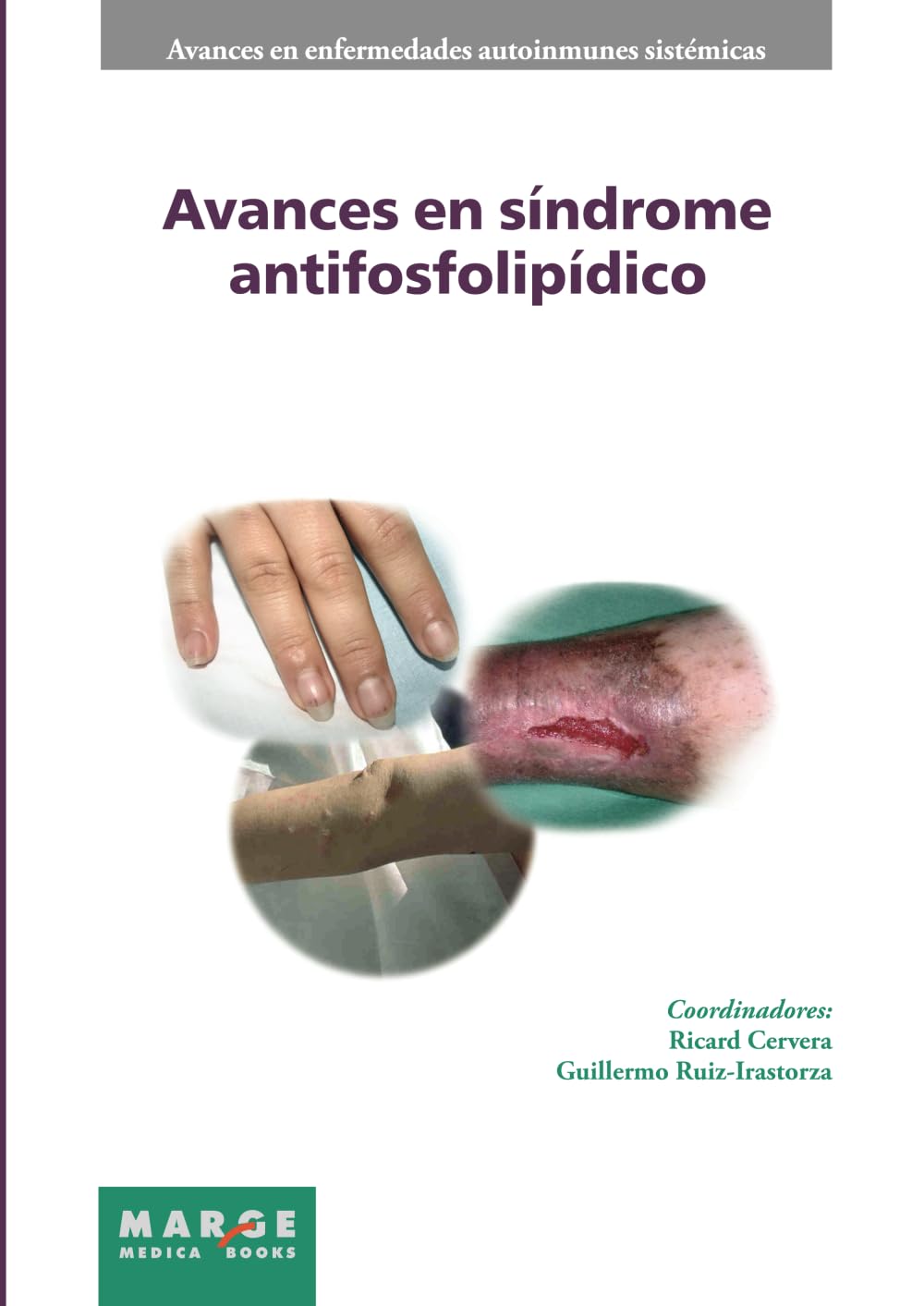 Libro: Avances en síndrome antifosfolipídico (Avances en enfermedades autoinmunes sistémicas)