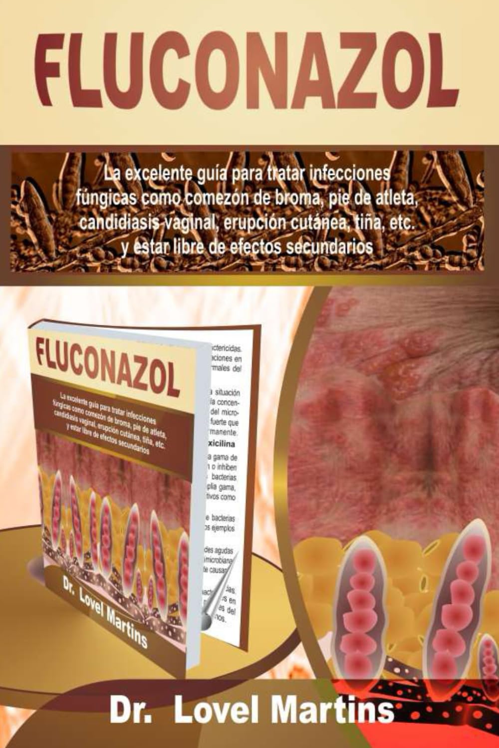 Libro: FLUCONAZOL: La excelente guía para tratar infecciones fúngicas como comezón de broma, pie de atleta, candidiasis vaginal, erupción cutánea, tiña, etc. y estar libre de efectos secundarios